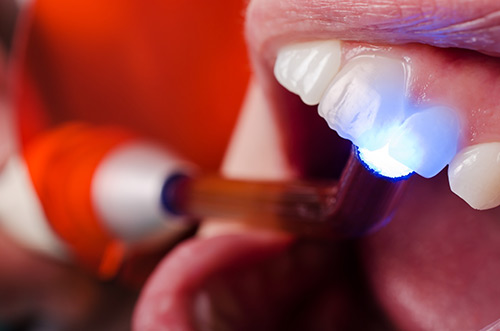 Der schnelle Weg zu perfekten Füllungen - Zahnarzt