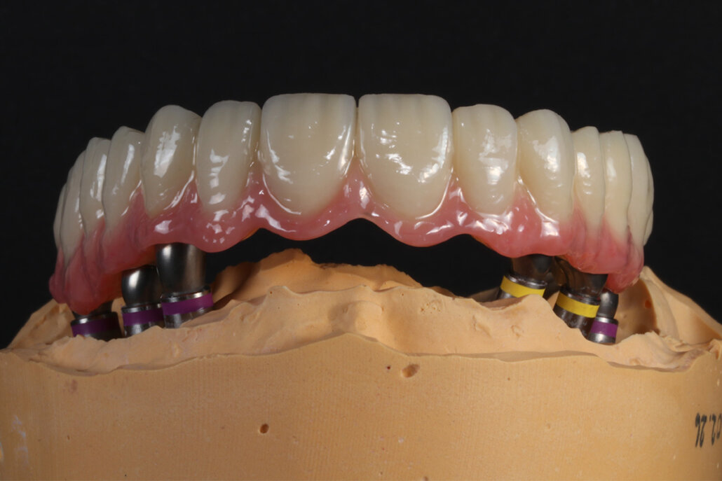 Implantate als Basis für festsitzenden Zahnersatz Festsitzender, implantatgetragener Zahnersatz, gefertigt im eigenen Labor